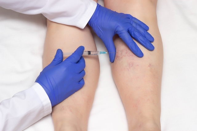 Escleroterapia com microespuma ecoguiada