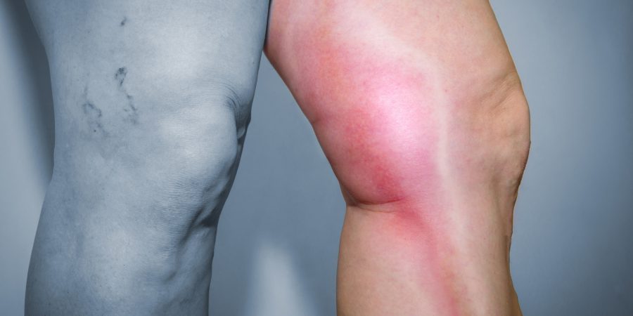Flebite (tromboflebite)